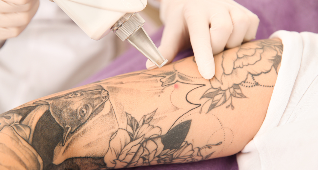 Informed decision for tattoo removal